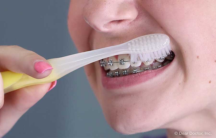 Brushing with braces.