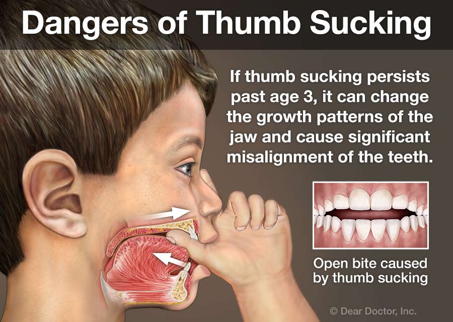 dangers-of-thumb-sucking